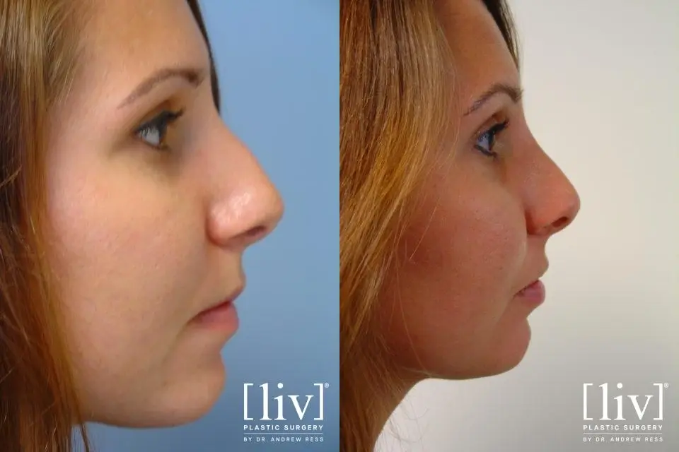 Rhinoplasty: Patient 9 - Before and After 1