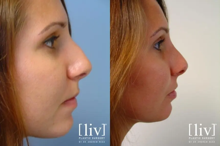 Rhinoplasty: Patient 2 - Before and After 1
