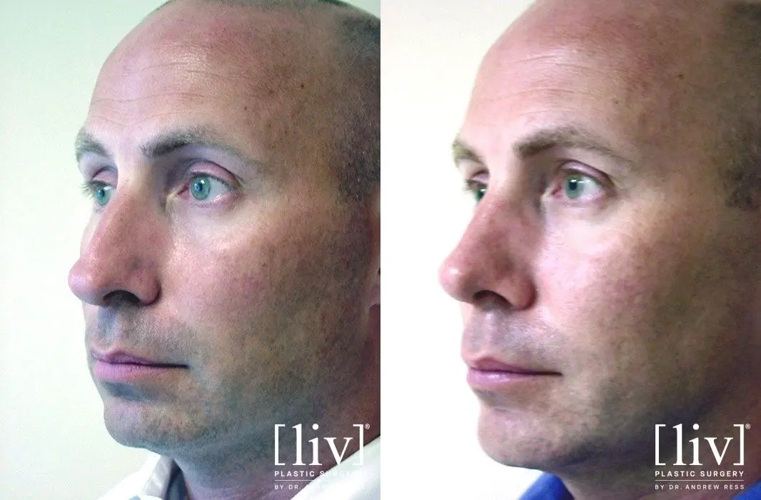 Rhinoplasty: Patient 20 - Before and After 4