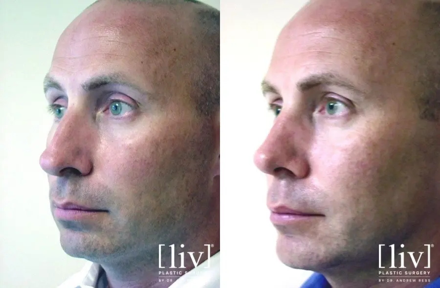 Rhinoplasty: Patient 12 - Before and After 4