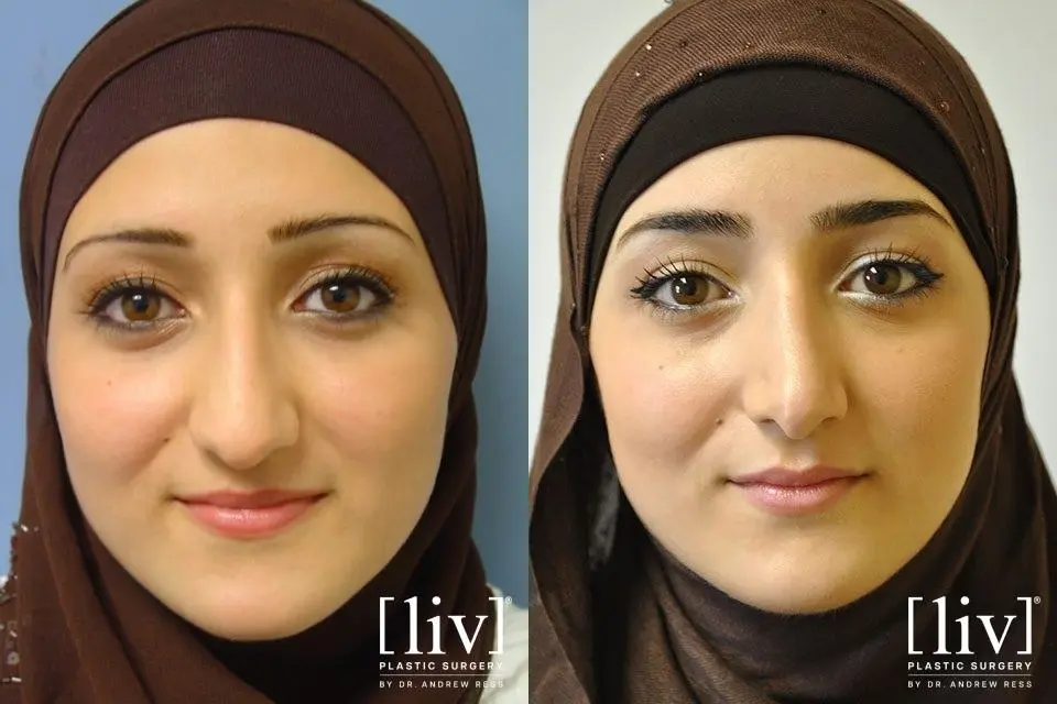 Rhinoplasty: Patient 5 - Before and After 1