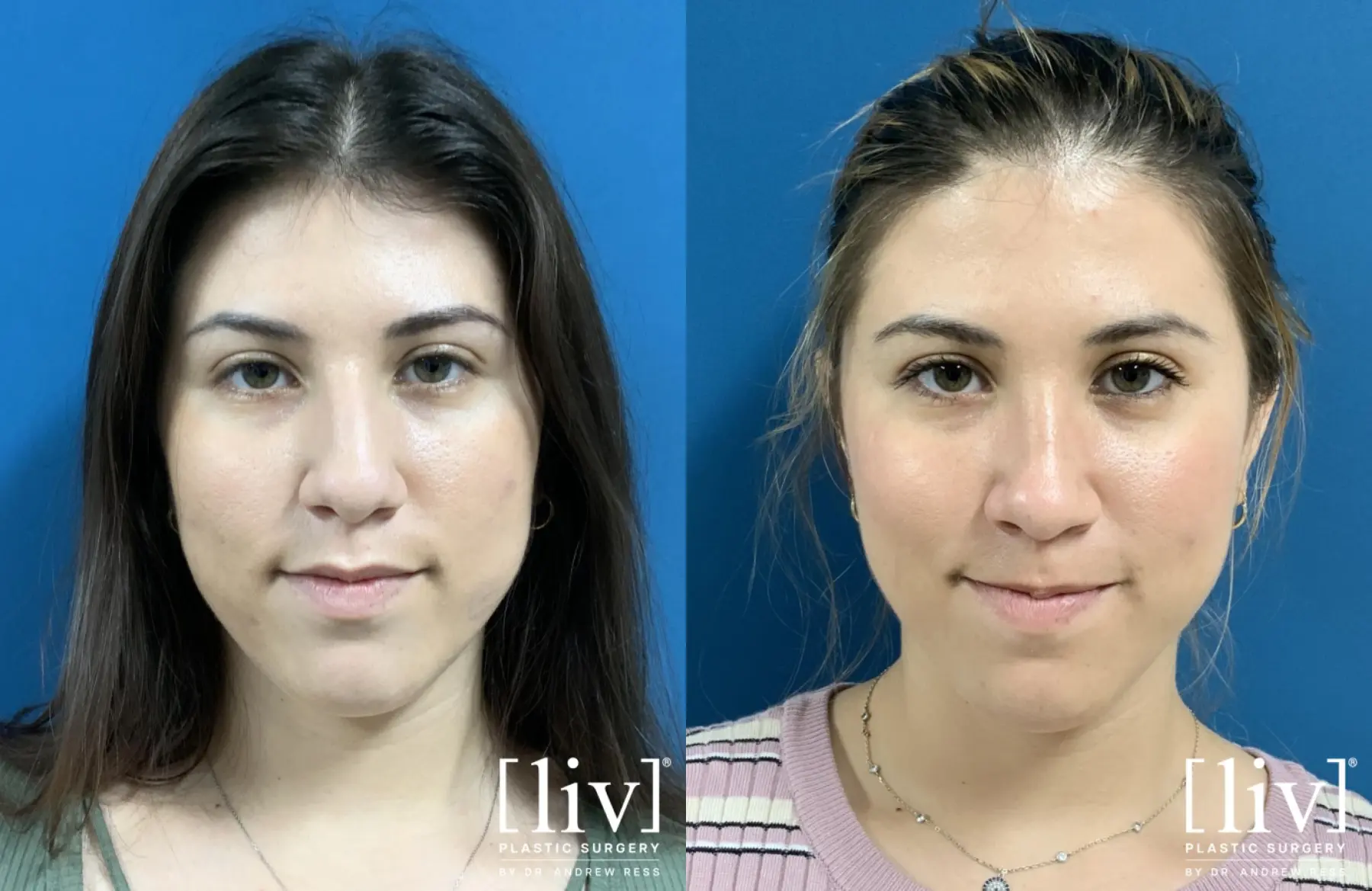 Rhinoplasty: Patient 6 - Before and After 1