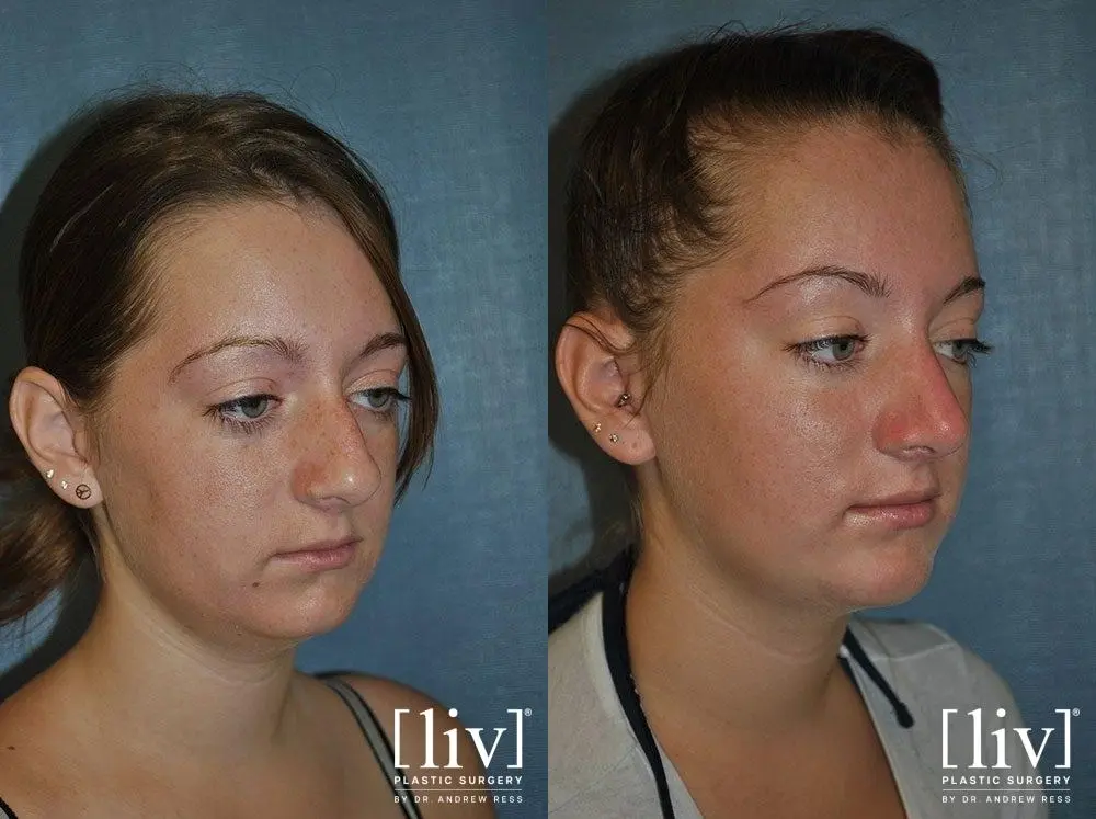 Rhinoplasty: Patient 11 - Before and After 2