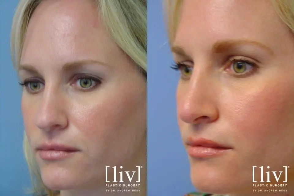 Rhinoplasty: Patient 22 - Before and After 2