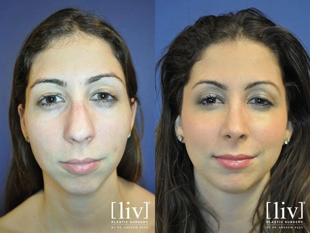 Rhinoplasty: Patient 14 - Before and After 1