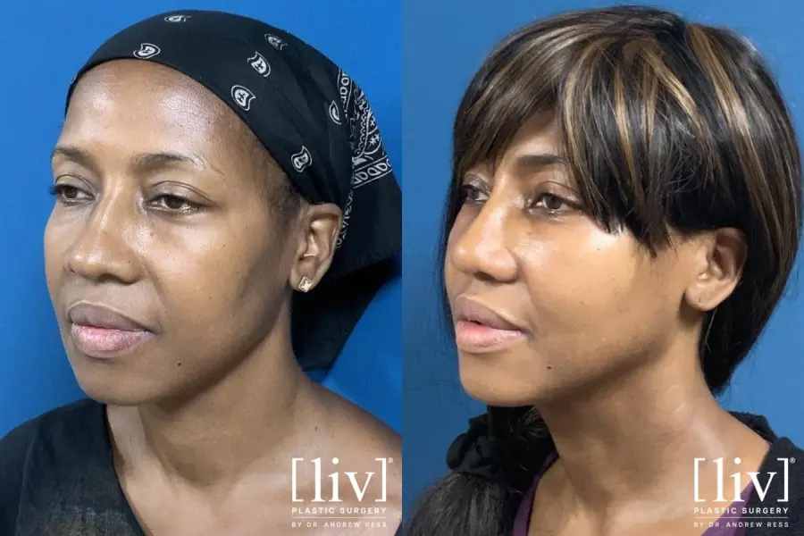 Rhinoplasty: Patient 17 - Before and After 2