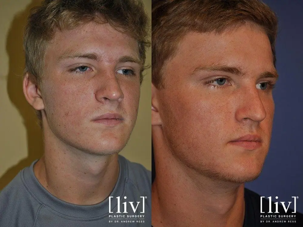 Rhinoplasty: Patient 13 - Before and After 2