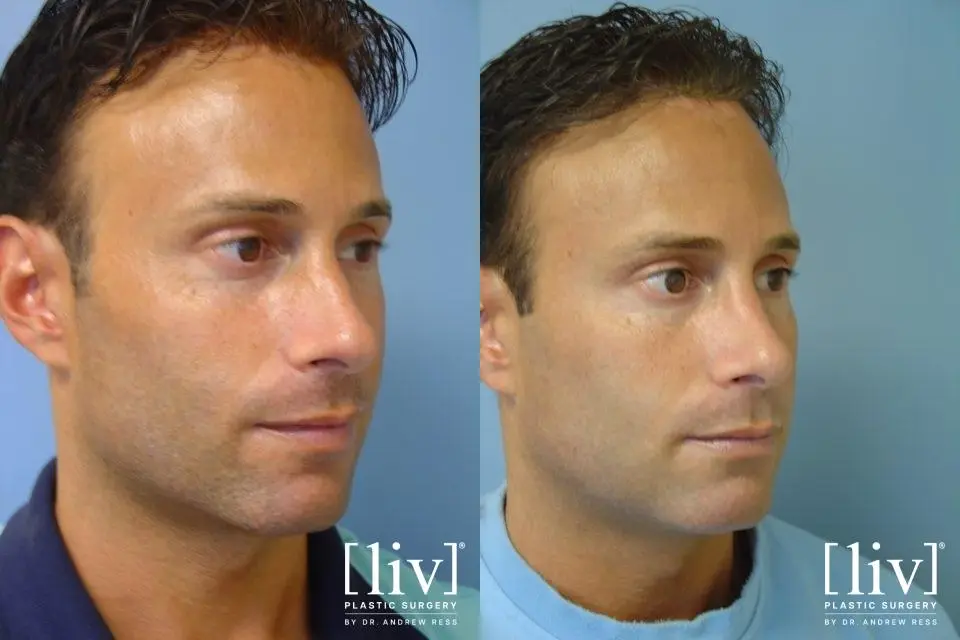 Rhinoplasty: Patient 21 - Before and After 4