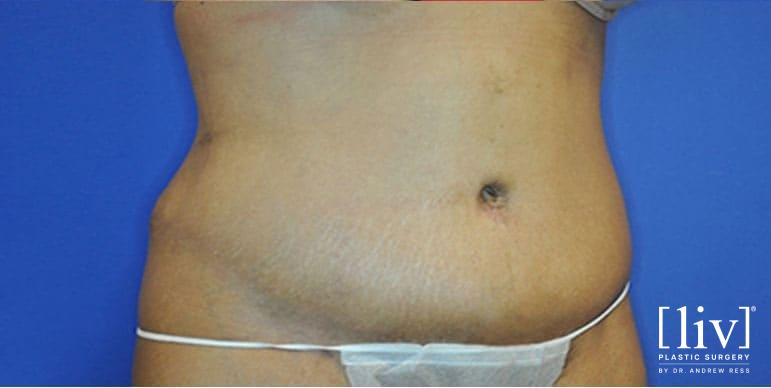 Lipoabdominoplasty - After 1