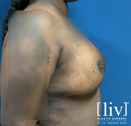 Breast Lift and Reduction - After 9