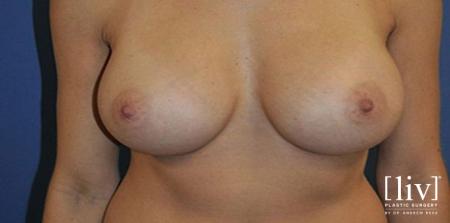 Breast Augmentation: Patient 8 - After 1
