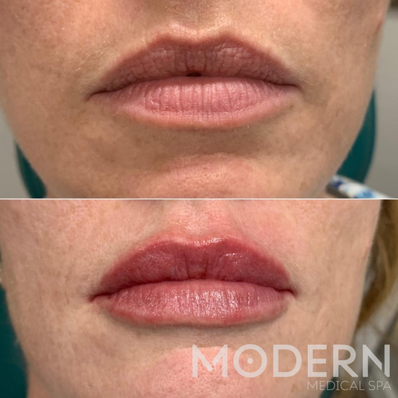 Restylane: Patient 11 - Before and After 