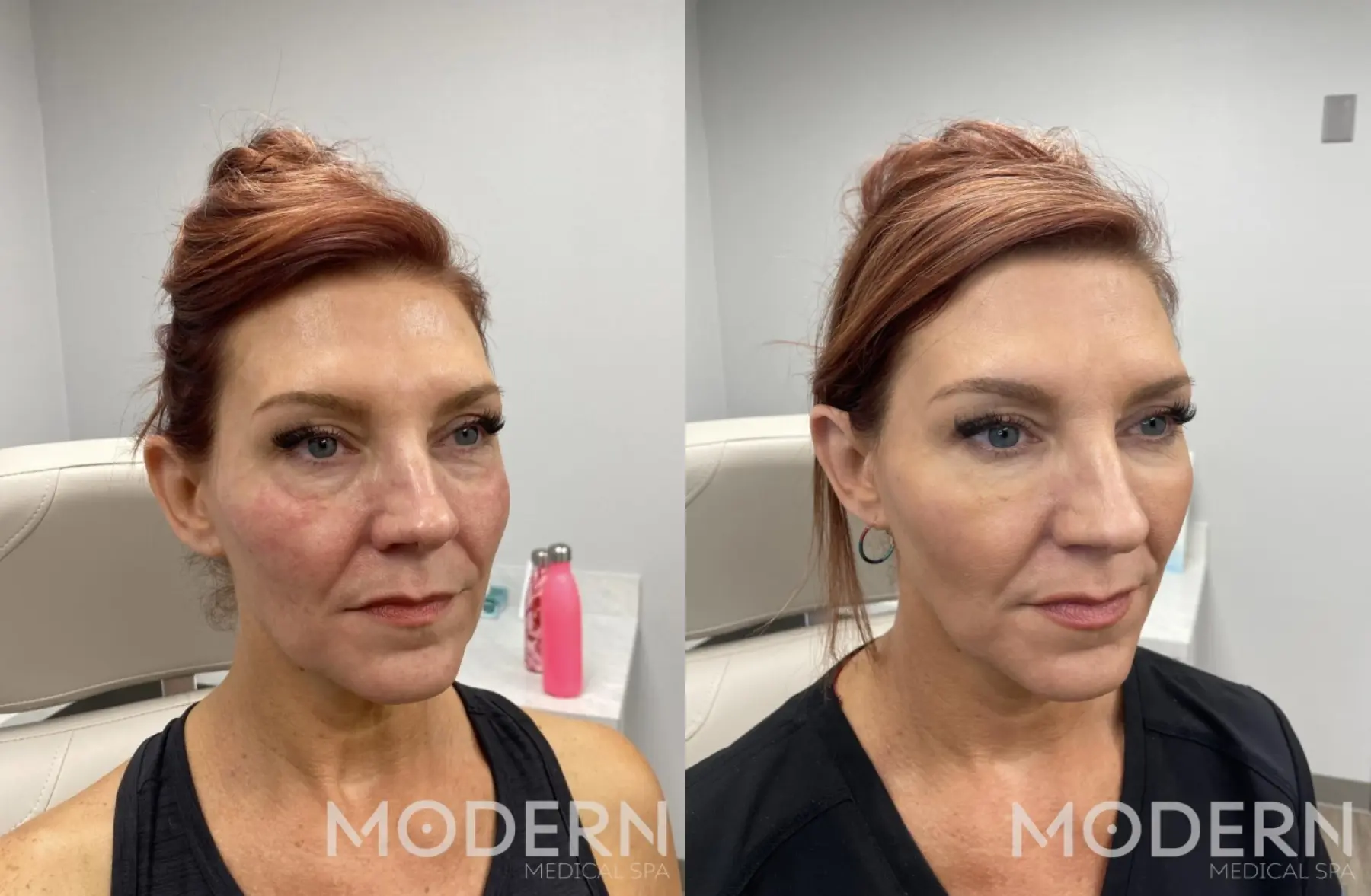 Use Juvederm Volbella to diminish fine lines and restore facial symmetry - Before and After