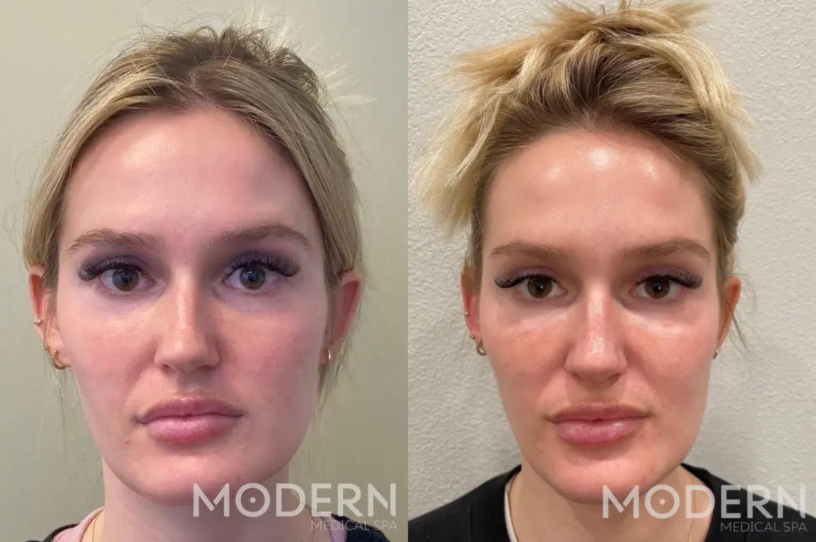 Use Juvederm Volbella to diminish fine lines and restore facial symmetry - Before and After