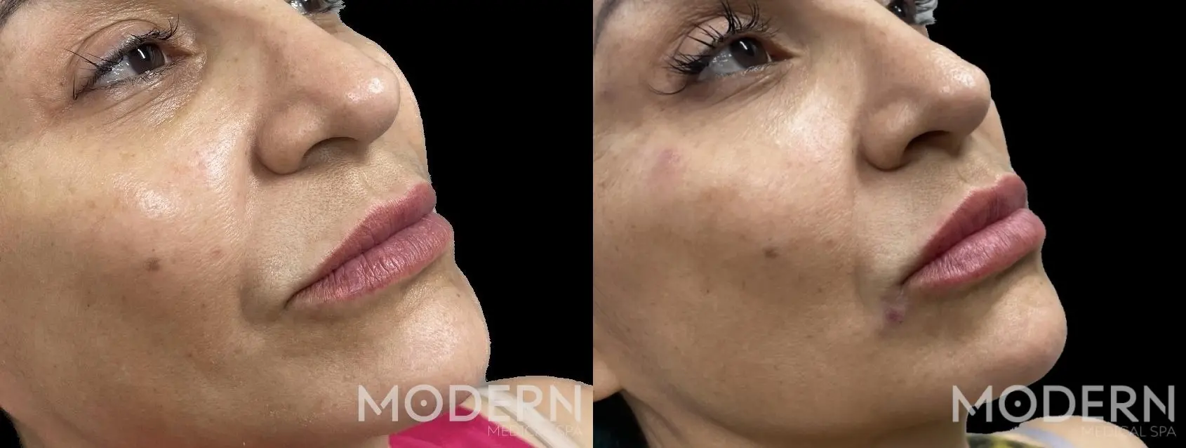 Use Restylane Kysse fdermal filler for volume and replenishing of the lips - Before and After