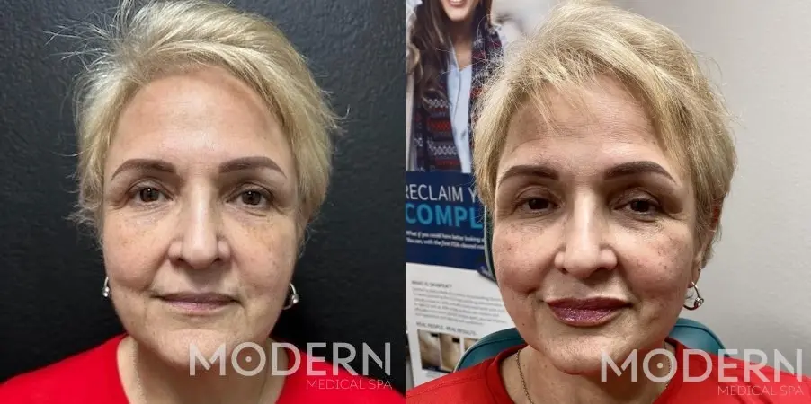 Restylane: Patient 13 - Before and After  
