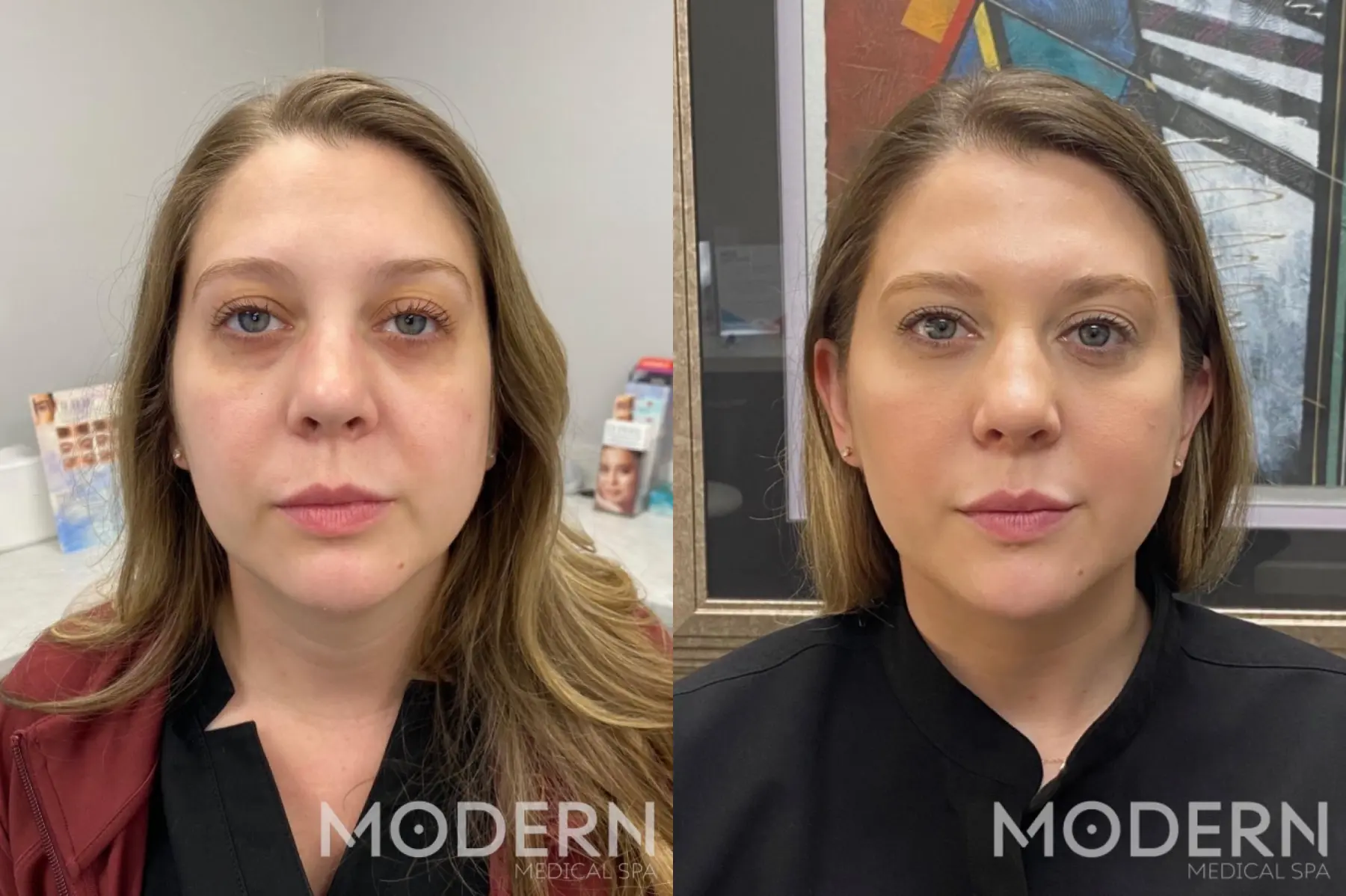 Use Restylane to restore volume to cheeks - Before and After  