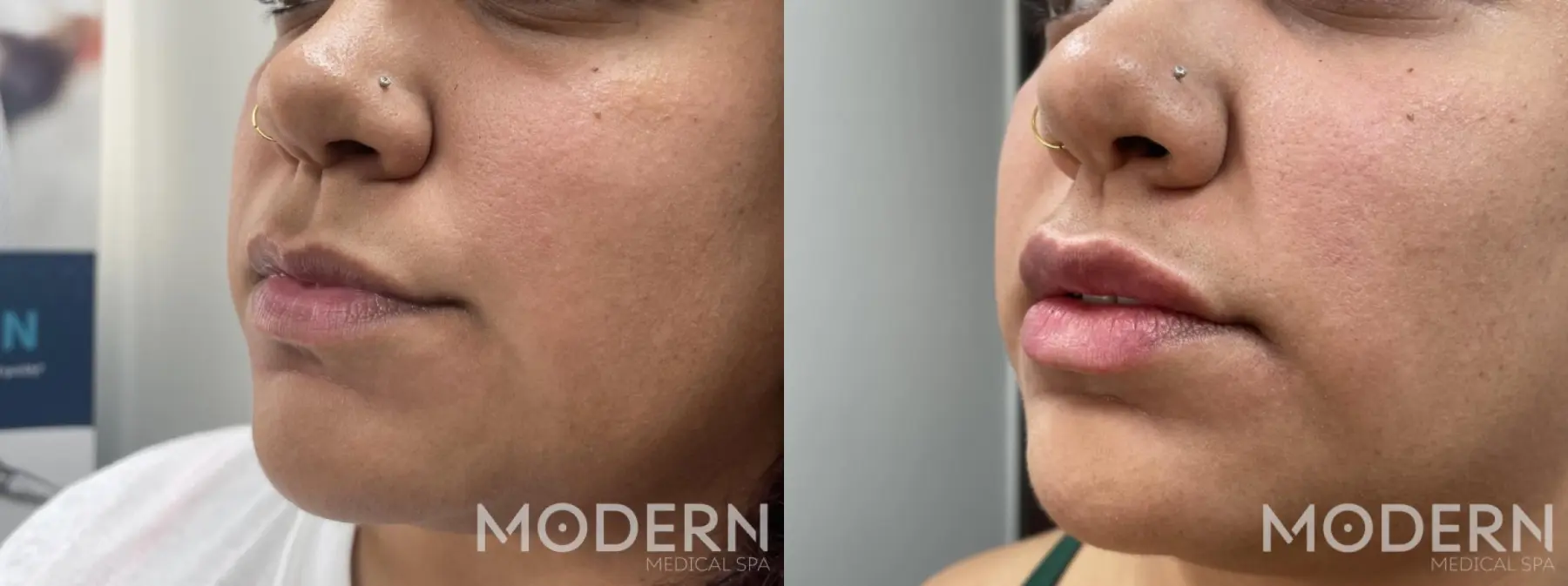 use dermal lip filler restylane kysse fior fuller lips - Before and After