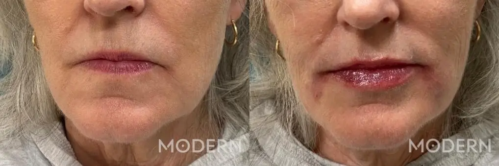 lower face - Before and After