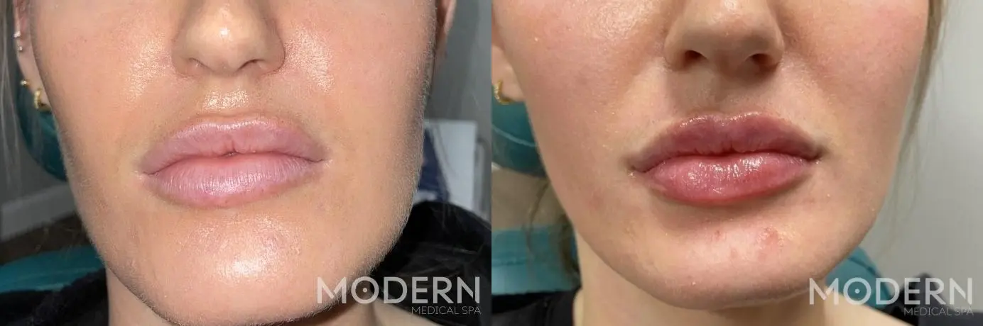 Restylane: Patient 12 - Before and After  