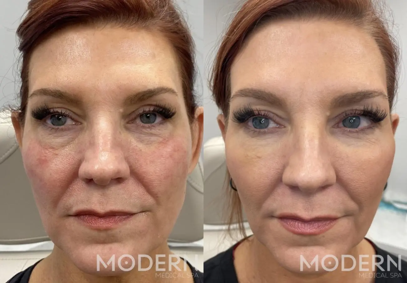 Restylane Contour restores facial volume - Before and After  
