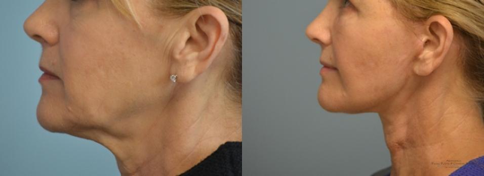 Facelift: Patient 10 - Before and After 4