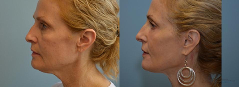 Facelift: Patient 6 - Before and After 2