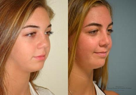 Rhinoplasty: Patient 33 - Before and After 5