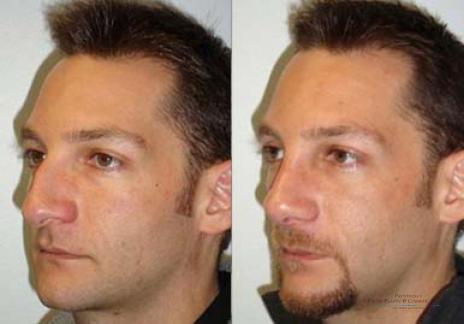 Rhinoplasty: Patient 28 - Before and After 1