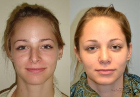 Rhinoplasty: Patient 34 - Before and After 1