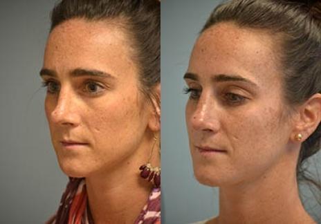 Rhinoplasty: Patient 30 - Before and After 6