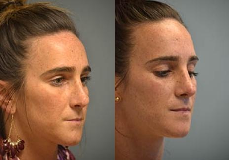 Rhinoplasty: Patient 30 - Before and After 5