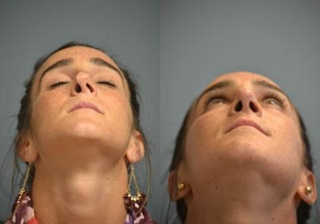 Rhinoplasty: Patient 30 - Before and After 1