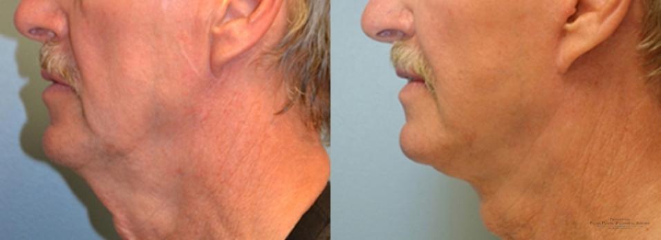 Facelift: Patient 5 - Before and After 3