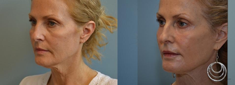 Facelift: Patient 6 - Before and After  