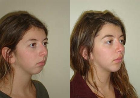 Rhinoplasty: Patient 31 - Before and After 3
