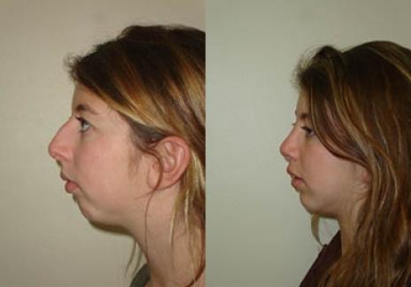 Rhinoplasty: Patient 31 - Before and After 5