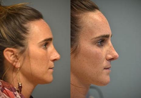 Rhinoplasty: Patient 30 - Before and After 4