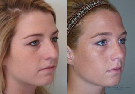 Rhinoplasty: Patient 29 - Before and After 2