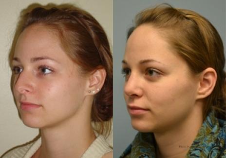 Rhinoplasty: Patient 34 - Before and After 2