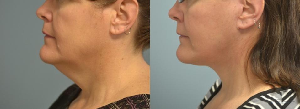 Facelift: Patient 7 - Before and After 2