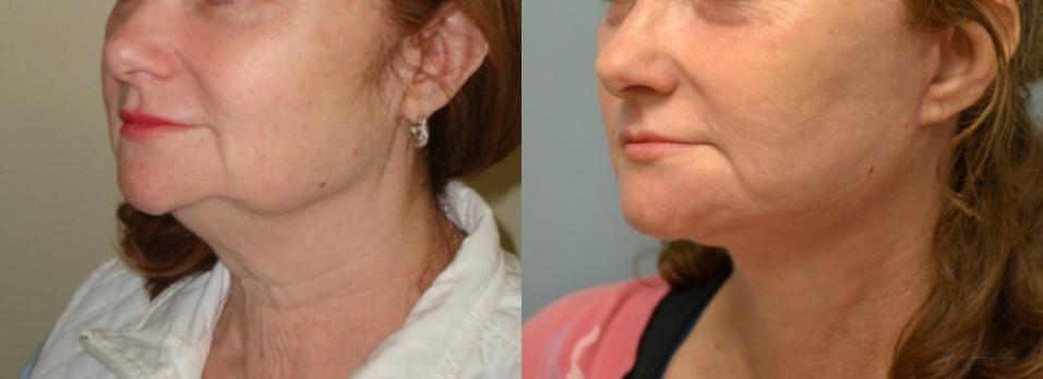 Facelift: Patient 2 - Before and After 2