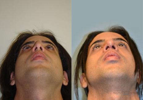 Rhinoplasty: Patient 19 - Before and After 4