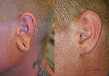 Otoplasty And Earlobe Repair: Patient 1 - Before and After  