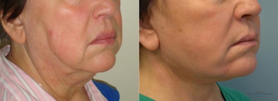 Facelift: Patient 4 - Before and After 1