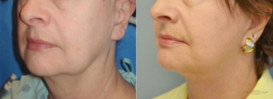 Facelift: Patient 4 - Before and After 2
