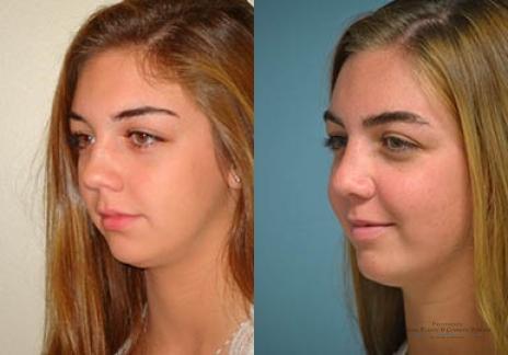 Rhinoplasty: Patient 33 - Before and After 3