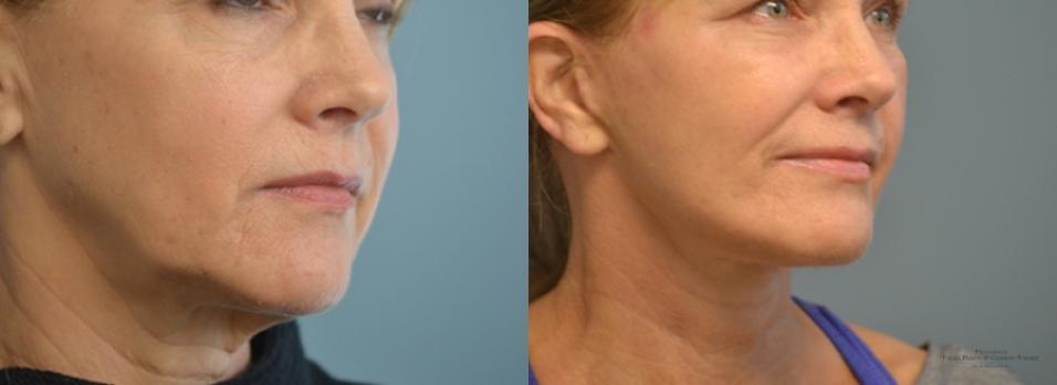 Facelift: Patient 10 - Before and After 2