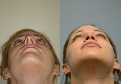 Rhinoplasty: Patient 34 - Before and After 4