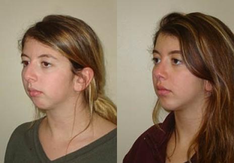 Rhinoplasty: Patient 31 - Before and After 6